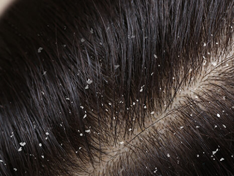 Best Homeopathic medicines for Dandruff