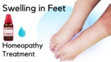 Swelling in Feet