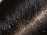 Dandruff
